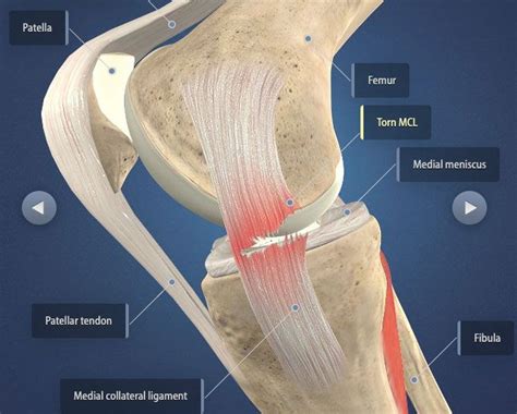 mcl acl tear recovery time